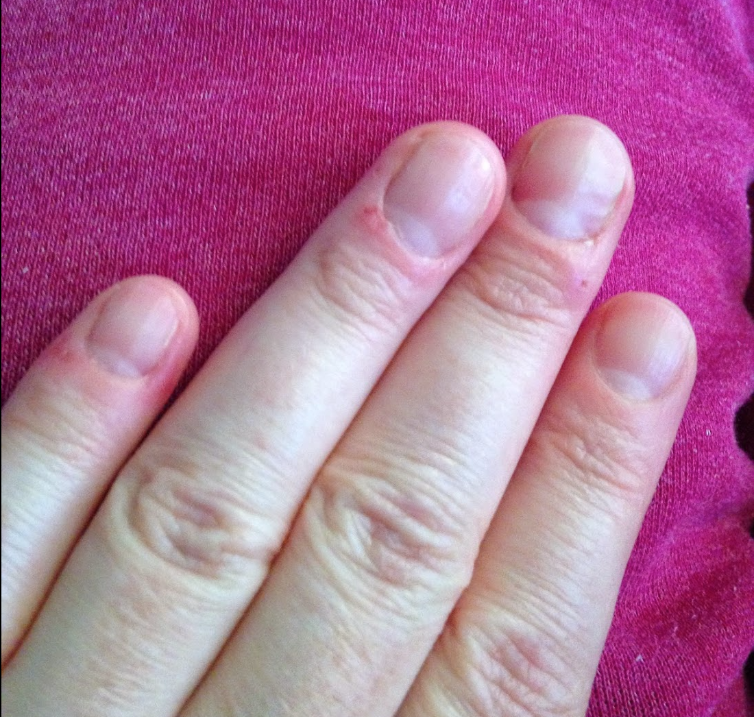 bad habits cuticle biting